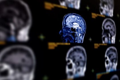 Os sinais da doença de Alzheimer precoce podem variar de pessoa para pessoa e progridem à medida que a doença avança – iStock/Getty Images