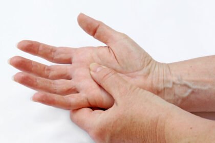 Colesterol alto pode apresentar sinais nas mãos