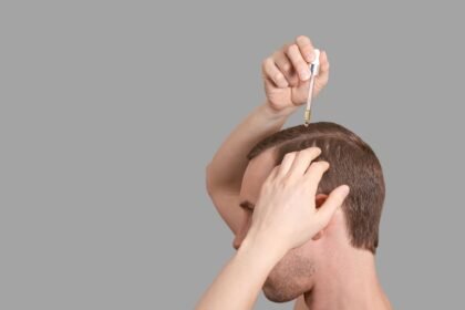 Minoxidil pode levar bebês à ‘síndrome de lobisomem’; entenda